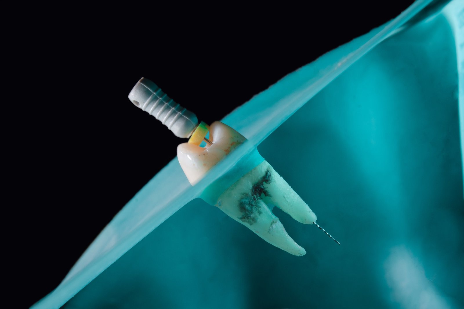 Root canal treatment illustration
