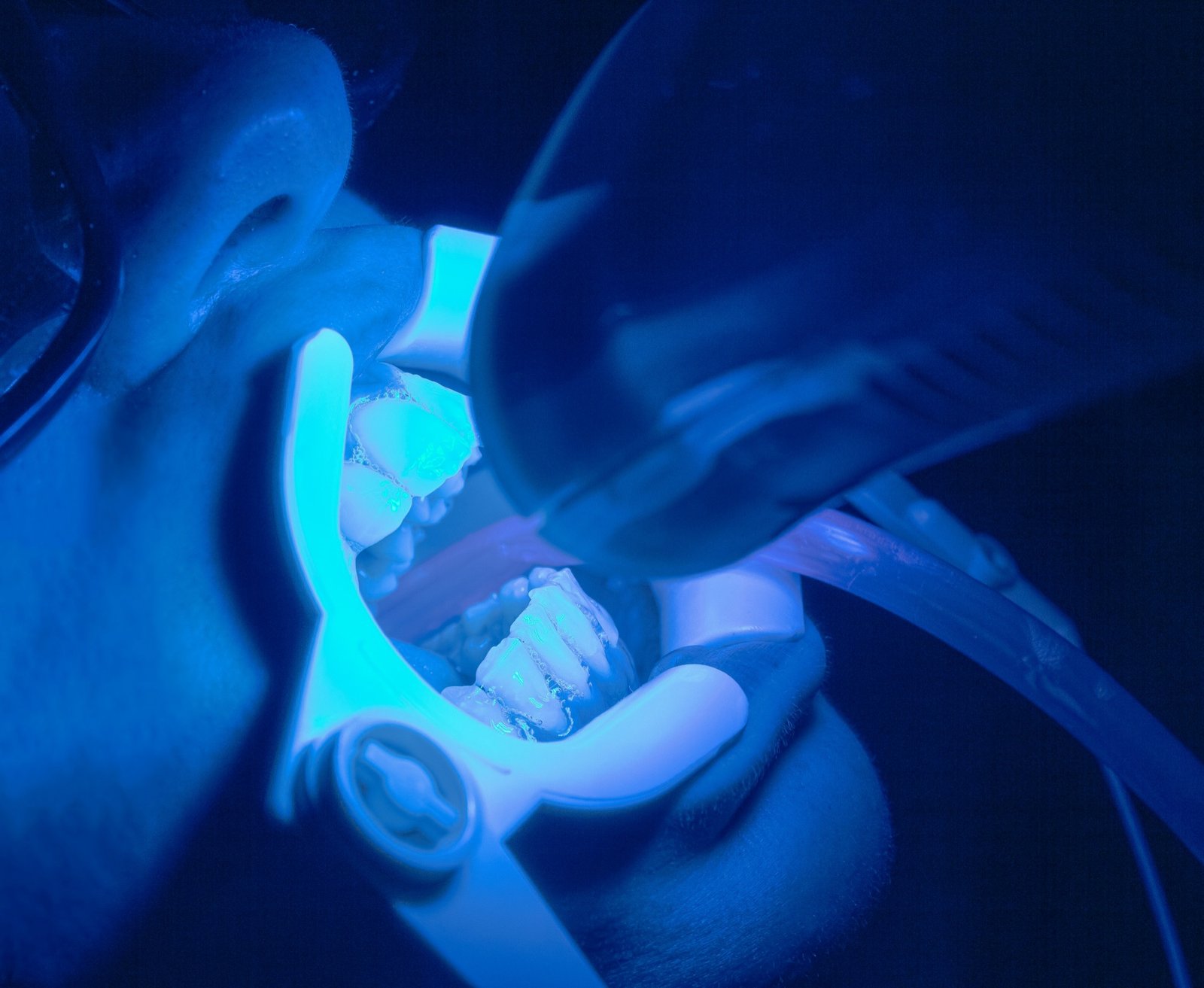 Professional teeth whitening with a blue light