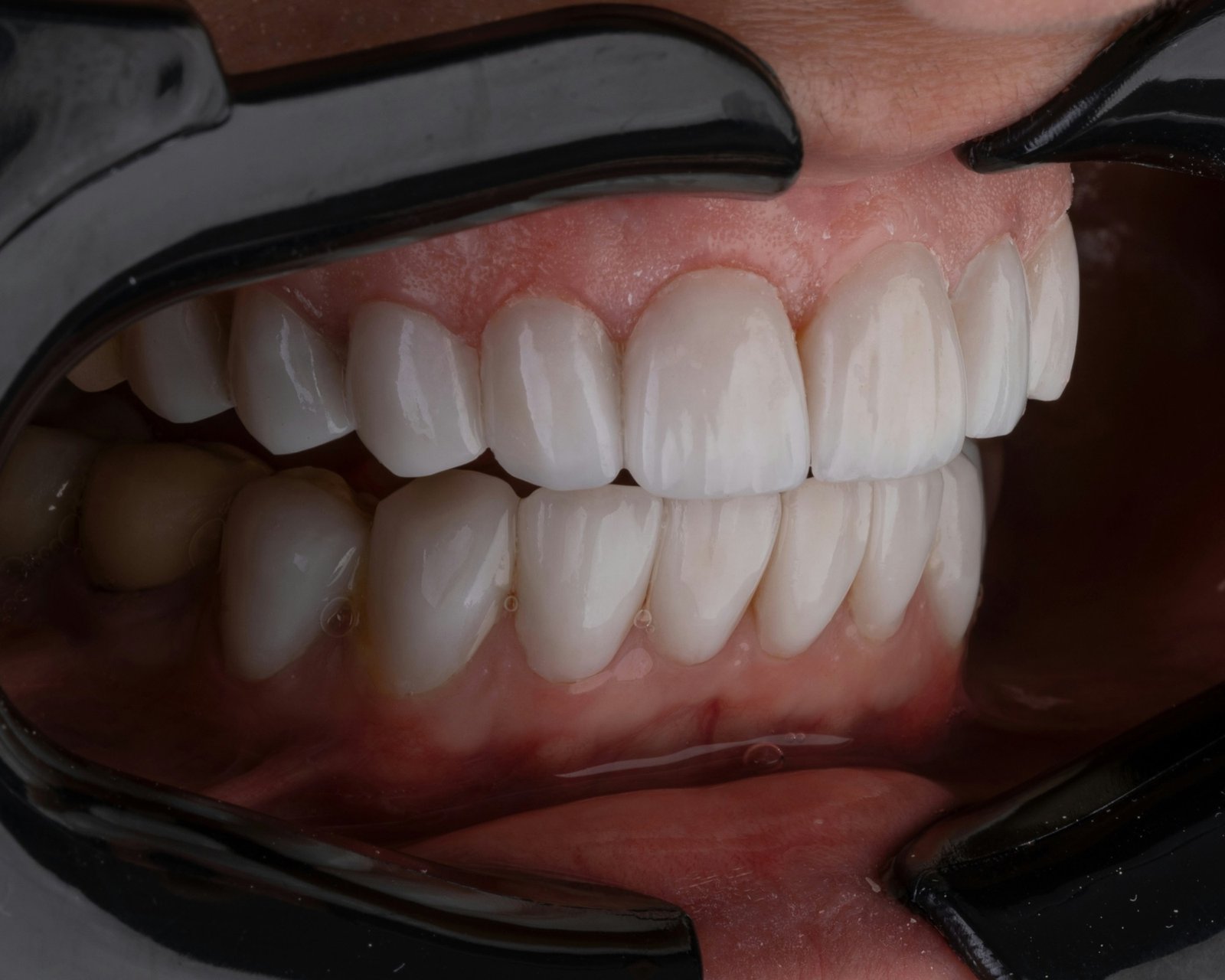 Close-up of a smile with porcelain veneers